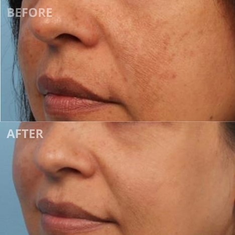 Spectra Laser Peel Treatment