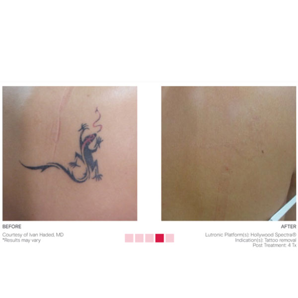 What You Need to Know About Tattoo Removal - em clinic Esthetic Medicine