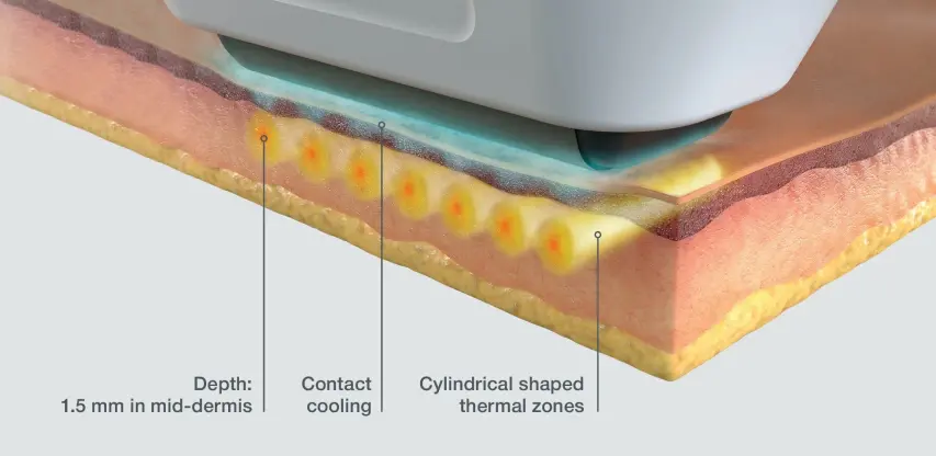 Sofwave 101: A Beginner’s Guide to Understanding Non-Invasive Facial Rejuvenation