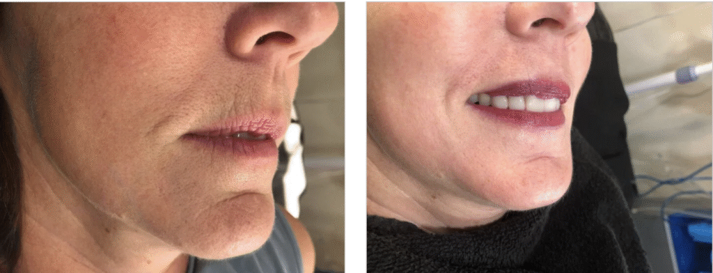 Lip Blush Before and After